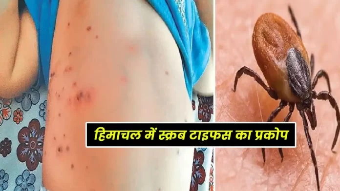 Woman dies of scrub typhus Chopal Himachal